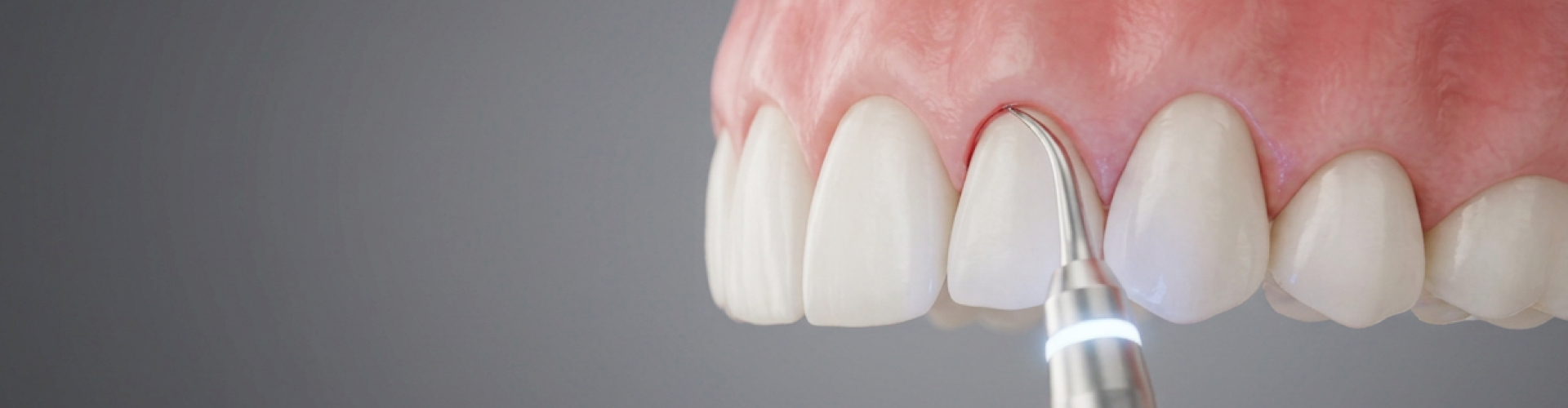 Close-up of laser gingivoplasty reshaping the gum line around a front tooth to improve smile symmetry and gum aesthetics.